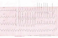 ECG showing pre-excited tachycardia.