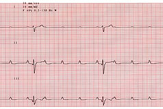 ECG showing heart block and failure of electrical conduction from atria to ventricles.